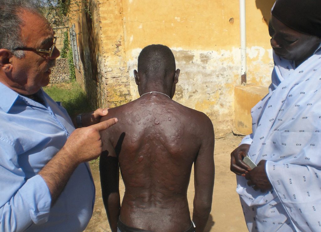 Dr. Emile Tanyous, für die DAHW im Sudan im Einsatz, lässt seine Patienten nicht im Stich. Hier untersucht er einen jungen Leprapatienten Foto: DAHW